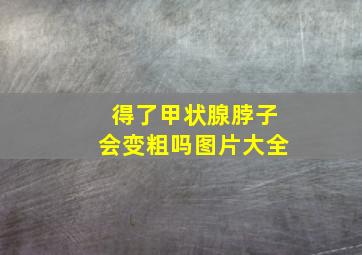 得了甲状腺脖子会变粗吗图片大全