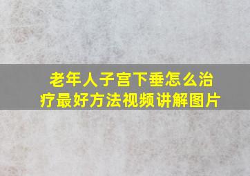 老年人子宫下垂怎么治疗最好方法视频讲解图片