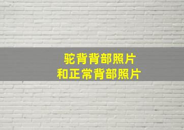 驼背背部照片和正常背部照片